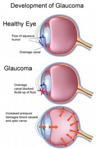 glaucoma-pic11